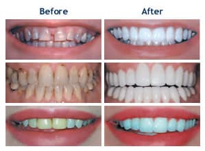 before and after smile makeovers in Gulfport